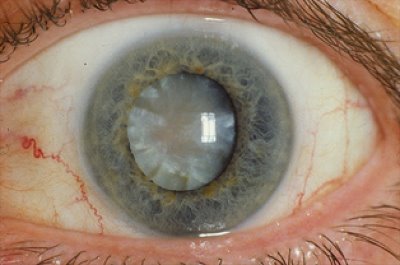 Cataract - Notice the cloudy lens;